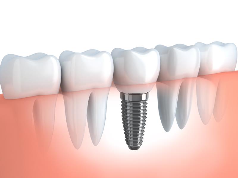 Dental Implants  Waynesboro, MS 