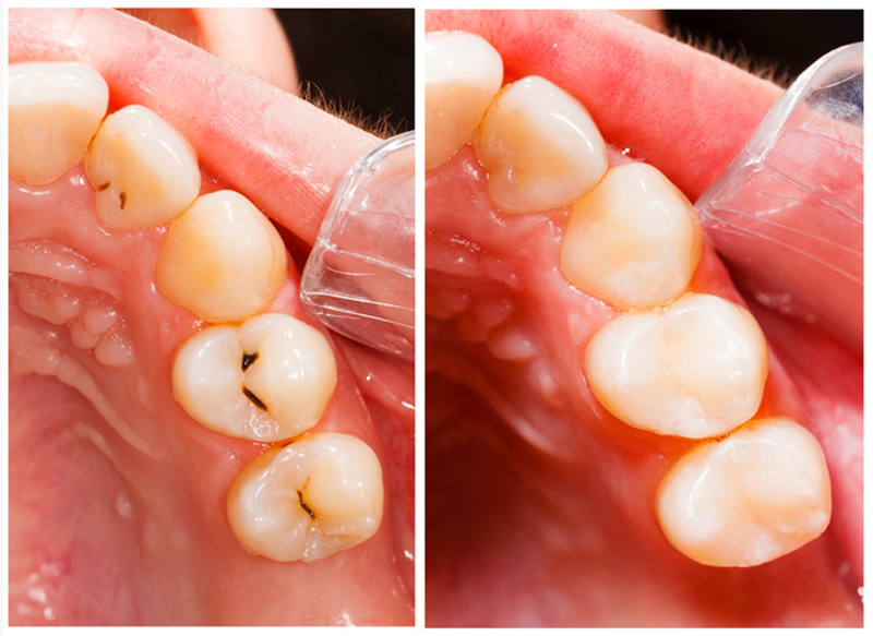 Fillings  Waynesboro, MS 