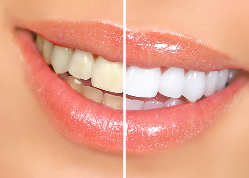 Teeth Whitening  Waynesboro, MS 